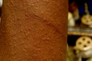 urticaria