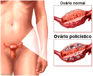 Ovario Policistico