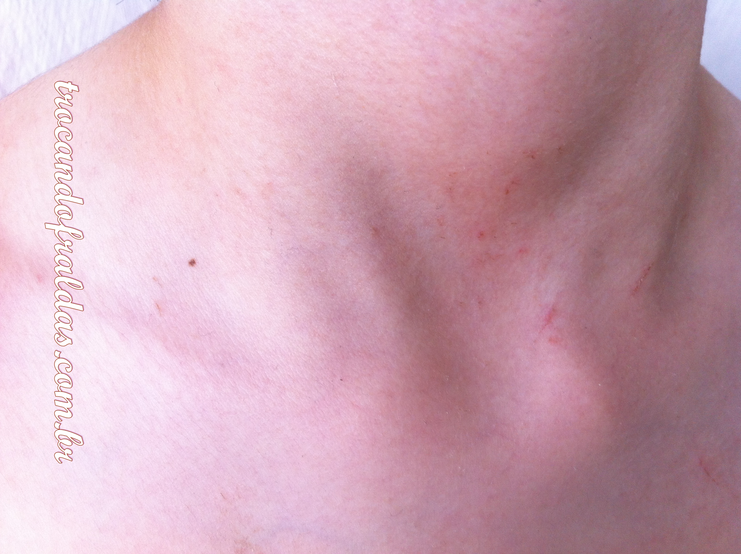 dermatite de contato 1