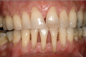 dentição definitiva