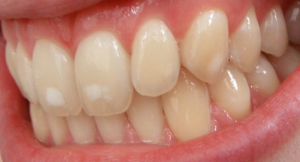 dente bonito