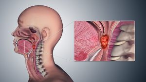 tumor na garganta