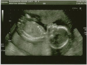 ultrasson 20 semanas