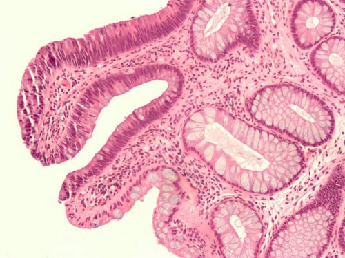 Polyps: What They Are and How to Treat Them | Famivita