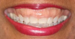 dentes curtos