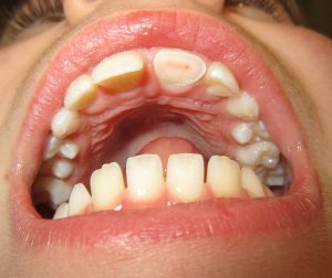 dente quebrado