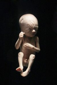 24-week fetus