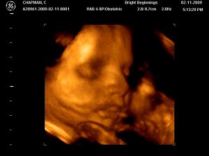 Ultrasound 4D