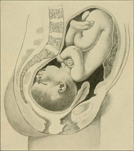 thinned cervix 1