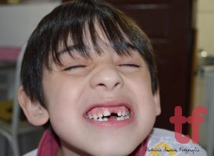 toothless child